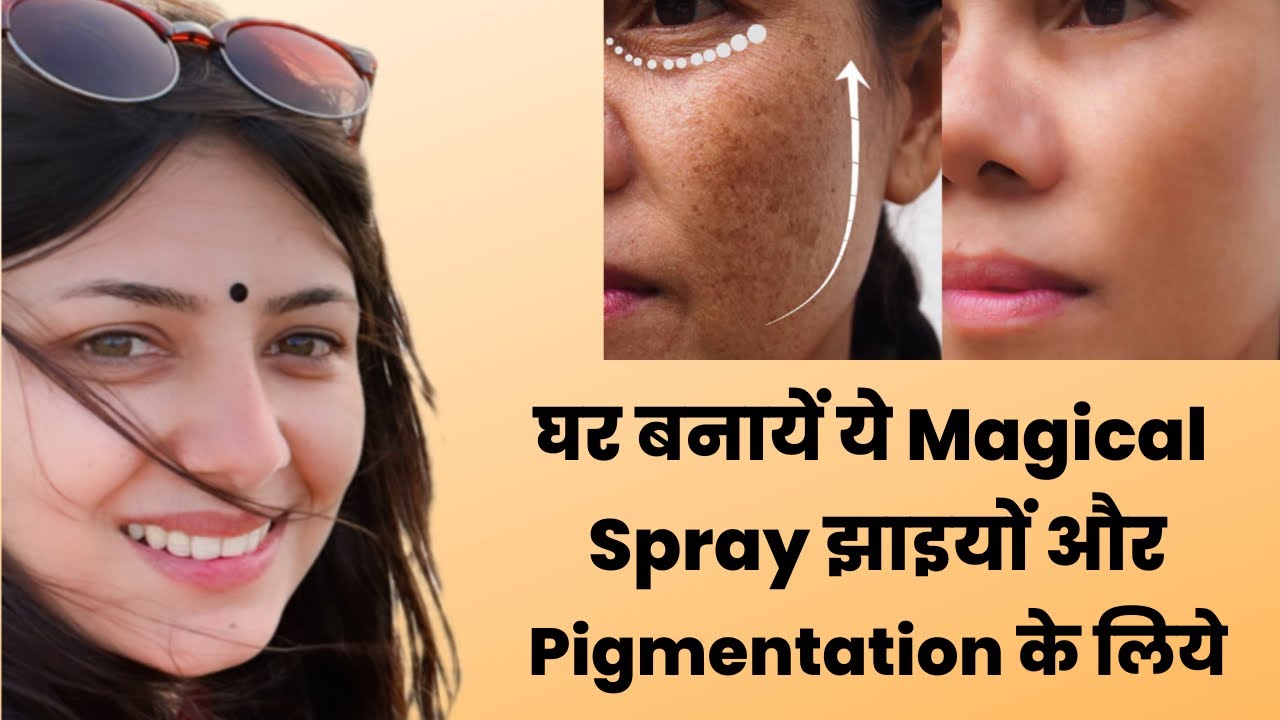 Magical Remedy for Pigmentation Hyperpigmentation Melasma Dark Spots