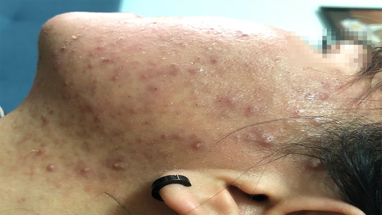 A Difficult Acne Case | Một Ca Mụn Khó