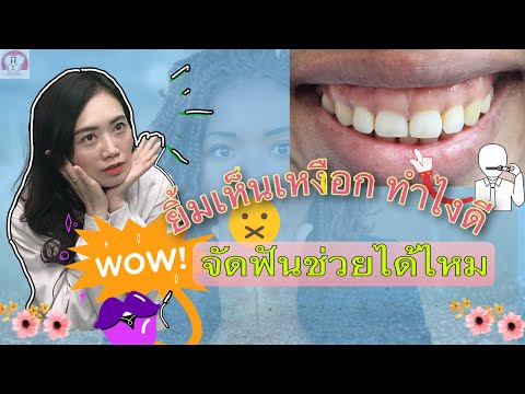 ยิ้มแล้วเห็นเหงือกทำไงดี จัดฟันแล้วช่วยได้ใหม/dental point pattaya /โดยหมอหลิน