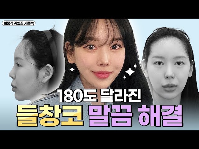 [VLOG] 들창코 해결~ 👃 콤플렉스 탈출 두번째 이야기
