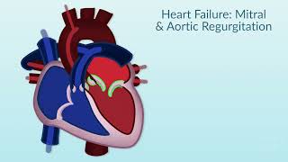 "Rheumatic Heart Disease" by Dr. Emmanuel Rusingiza