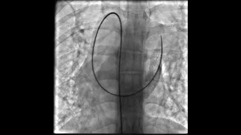 IVC interruption with azygous continuation to Right SVC and persistent Left SVC to coronary sinus