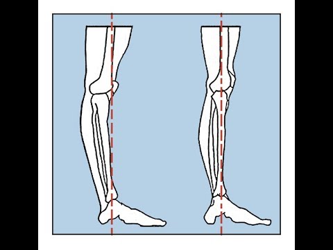 Video: Betyder hyperekstenderede knæ?