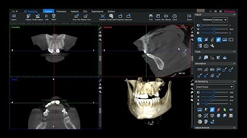 Evaluating a Single Tooth in Romexis 6.1