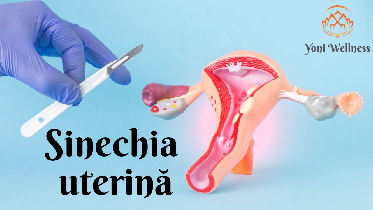 S2 Ep 51 Sinechia Uterin Sinechia Cervical Sdr ASHERMAN s2-ep-51-sinechia-uterin-sinechia-cervical-sdr-asherman