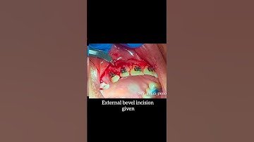 How to do Gingivectomy with scalpel#dentistry#doctor#dental #world #dentist #reels#trending