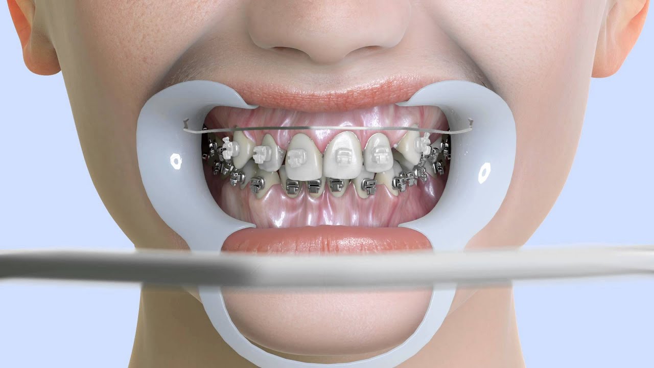 How Braces Work - YouTube