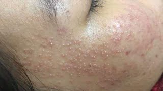 Acne Treament Under The Skin #047