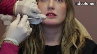 Lip Filler on Thin Lips | Start to Finish with 1 Syringe of Juvederm
