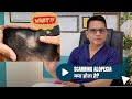 Scarring alopecia  lichen planopilaris  hair fall treatment in delhi  dr jangid  skinqure delhi