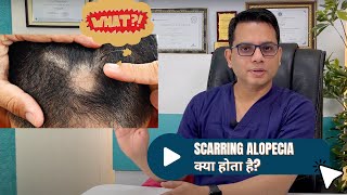 Scarring Alopecia | Lichen planopilaris | Hair fall Treatment in Delhi | Dr Jangid | SkinQure Delhi