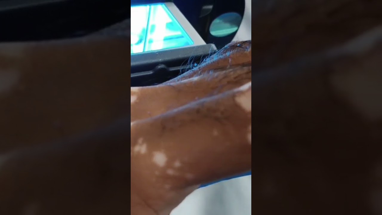 excimer laser | white spots | vitiligo |hypopigmantation 