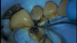 Crown preparation with buildup - mandibular left second permanent premolar 1/5 