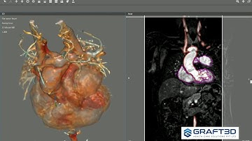 HEART Segmentation in D2P software. Customizes investigation of heart valves in 3D Segmentation .