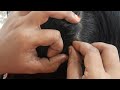Nitpick by sister hair teny nits in her hairpr nitpicking channel