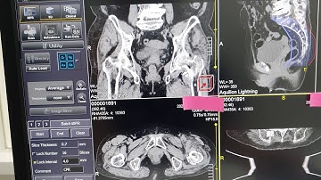 CT Curved MPR Sacrum Coronal view