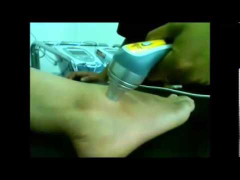 usa map LASER aplicación punto y barrido por puntos