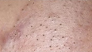 🤯 ULTIMATE Blackhead Removal! So Satisfying, You Won