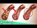 Arteriosklerose rückgängig machen? | Dr.Heart