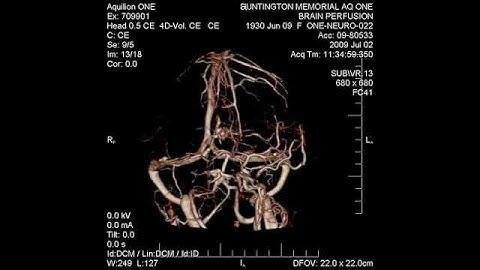 Brain_Perfusion2.avi