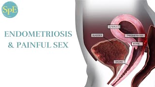 Video 2: Endometriosis \& Painful Sex