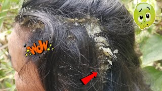 Dandruff Scratching, Itchy Dry Scalps, Psoriasis, Huge Flakes Removal #85