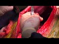 How to perfom a gastropexy in a dog  vetgirl veterinary continuing educations