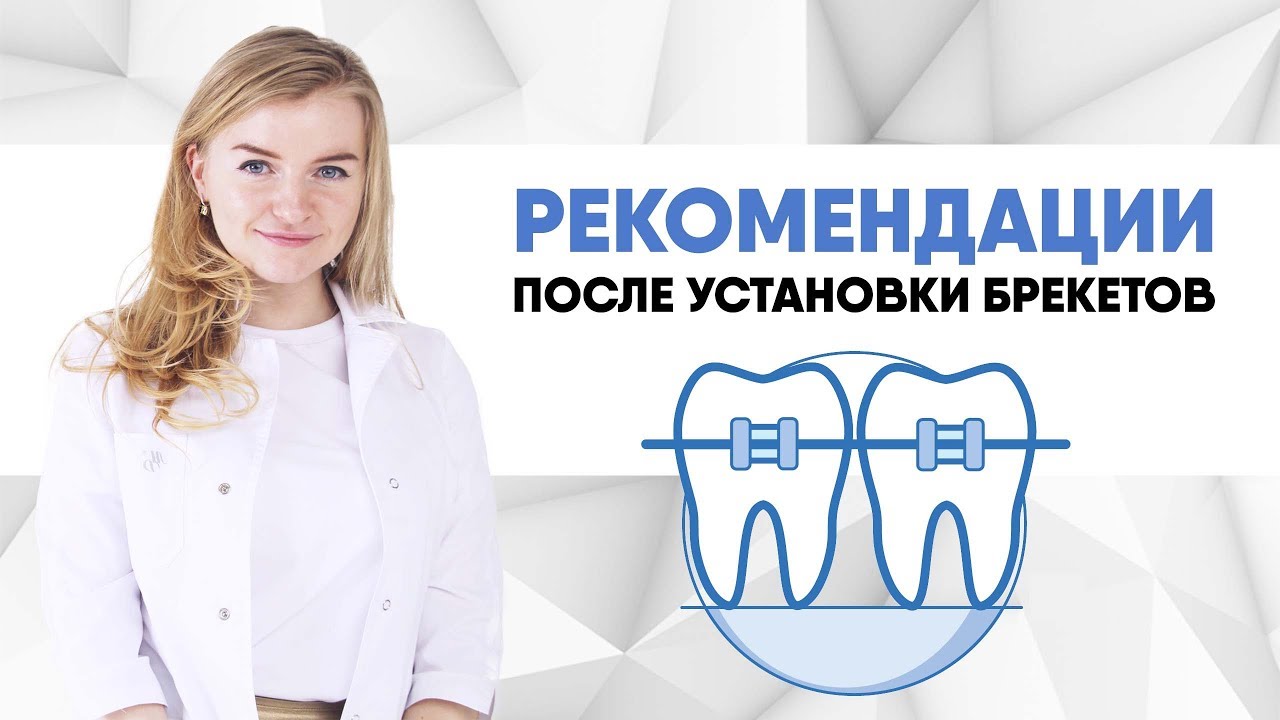 Рекомендации после установки брекетов