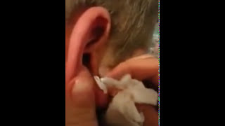 Squeezing white worm pimple