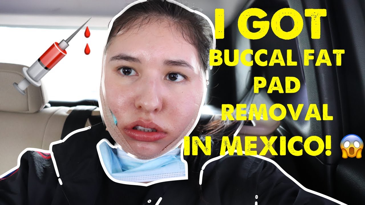 I GOT BUCCAL FAT REMOVAL IN MEXICO!!! Vlog Part 1 YouTube
