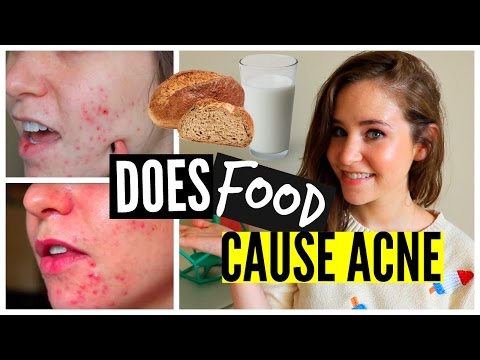 How To Get Rid Of Acne Naturally: Food, Diet, Wheat, Dairy, Sugar, Causes of Acne