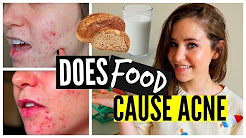 How To Get Rid Of Acne Naturally: Food, Diet, Wheat, Dairy, Sugar, Causes of Acne