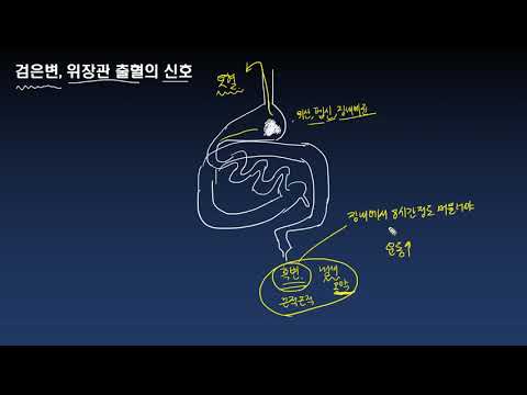 검은변(melena), 위장관 출혈의 신호