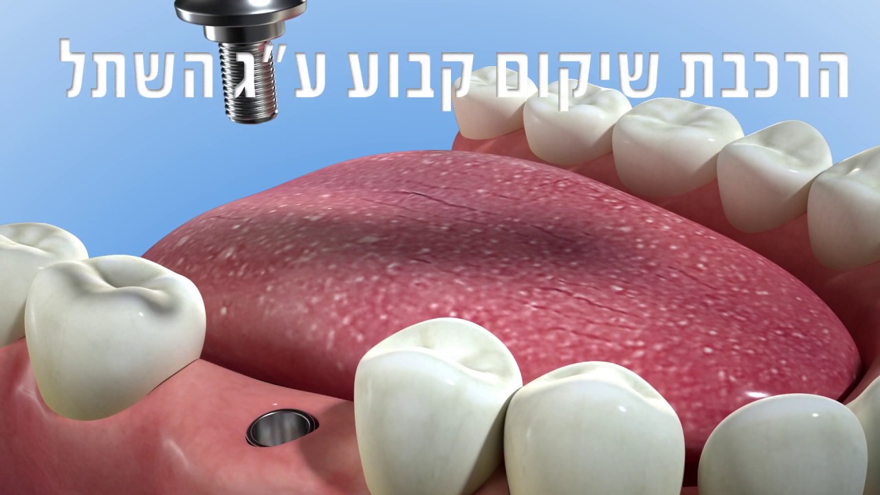 התקנת שתל דנטלי