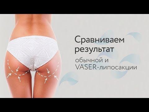 Сравниваем результат обычной и VASER -липосакции