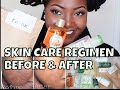 ACNE SKIN CARE REGIMEN | ACNE.ORG| FRANKS BODY SCRUB REVIEW | BEFORE AND AFTER