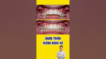 Hành trình niềng răng hô để có nụ cười đẹp xinh #nhakhoa #bacsidieutaithu #niengrang #chinhnha