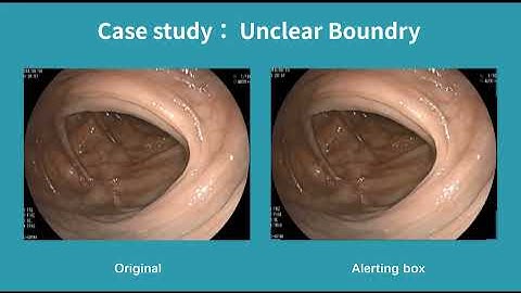 Real-Time Polyp Detection AI For Unclear Boundry Cases