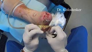 Split Thickness Skin Graft on the foot Reveal