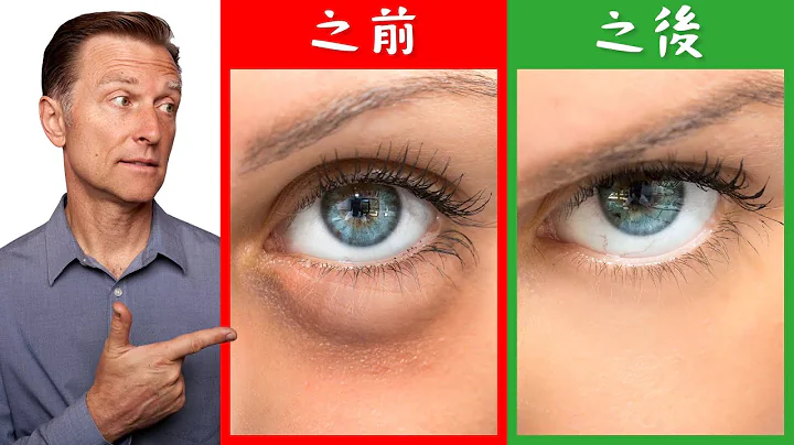 消除眼睛浮腫,黑眼圈的自然療法,柏格醫生 Dr Berg - 天天要聞