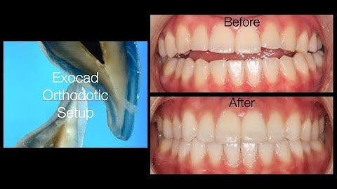 ExoCad Orthodontic Set up - Non Surgical Treatment of Anterior Open Bite