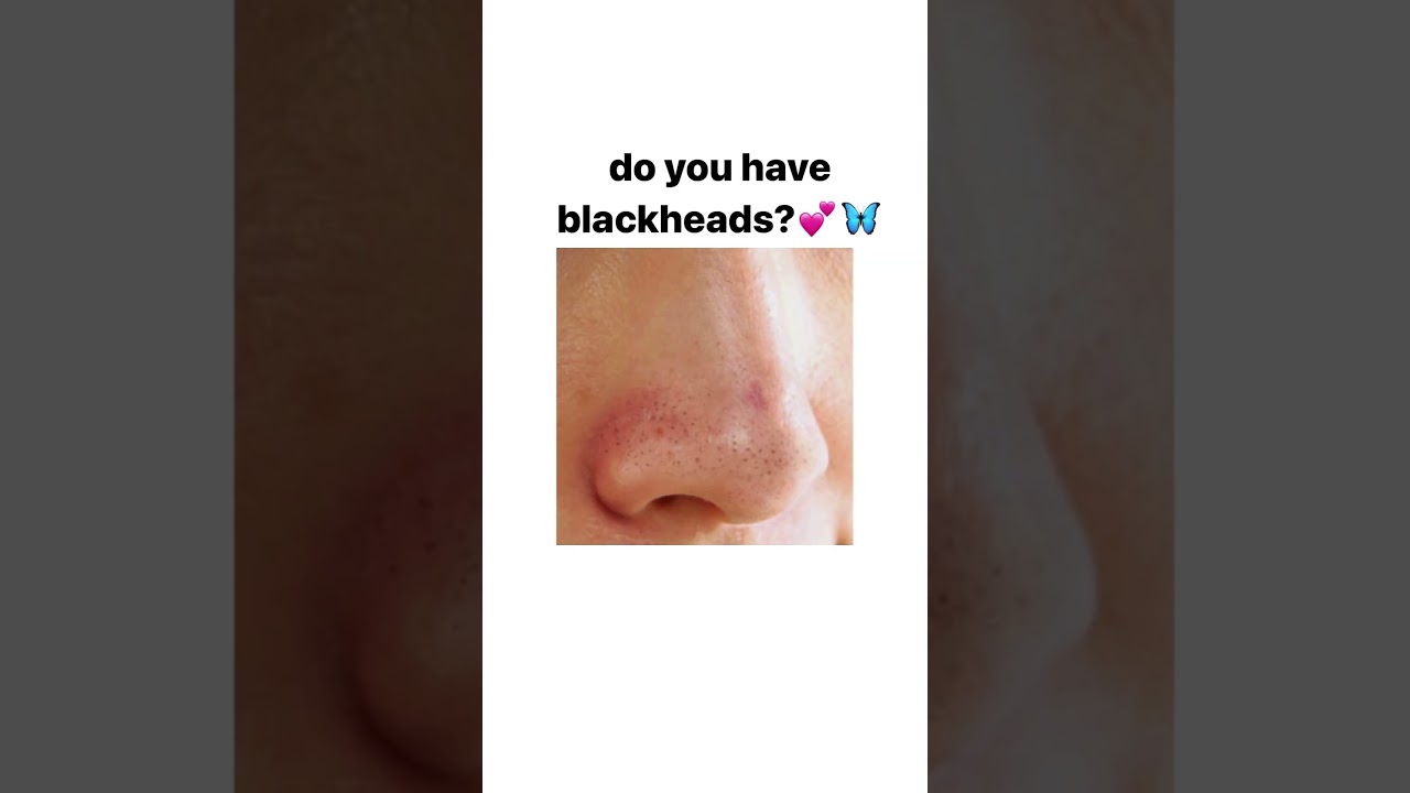 Use this 2-3 times a week💕🦋#acnetips #glowingskin #blackheadremoval #skincare