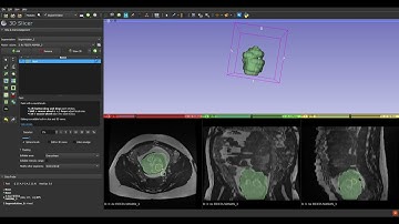 3D Slicer segmentation edition example