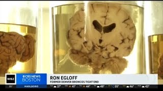 Boston University CTE study may lead to living diagnosis