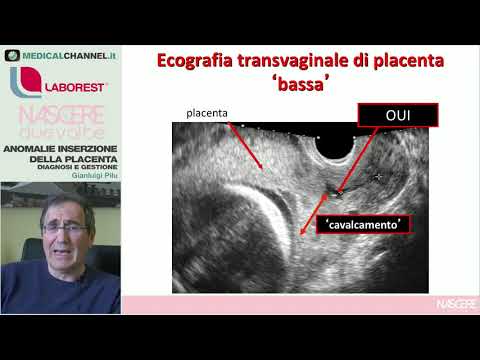 Anomalie di inserzione della placenta: diagnosi e gestione