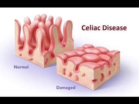 Video: Dīringa Herpetiformis Dermatīts - Simptomi, ārstēšana