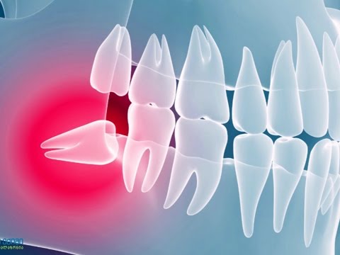 \"სიბრძნის კბილი\" - რა პრობლემები ახლავს და როდისაა საჭირო მისი ექსტრაქცია