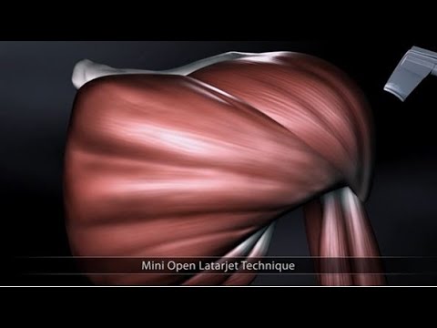 Mini Open Latarjet Technique