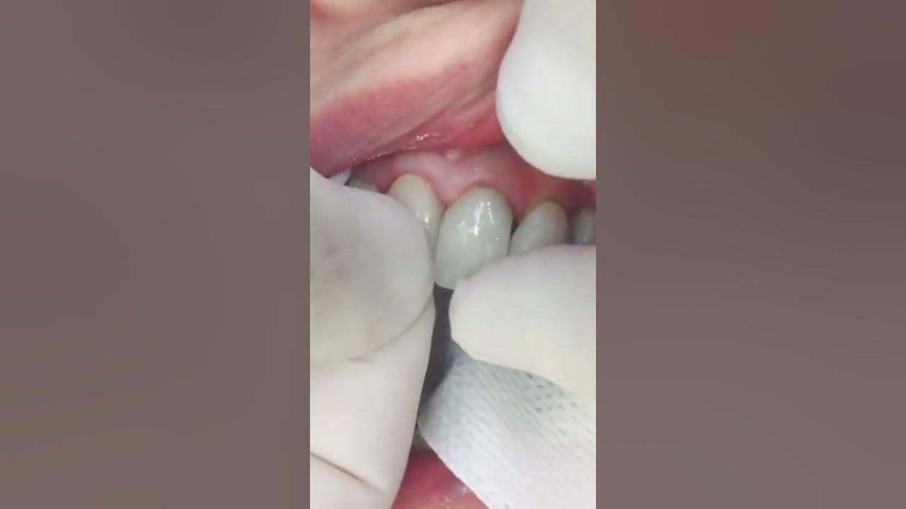 How Dentists Replace The Two Front Teeth With Crowns View Mobile