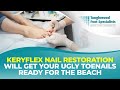 Keryflex Nail Restoration Will Get Your Ugly Toenails Ready for The Beach